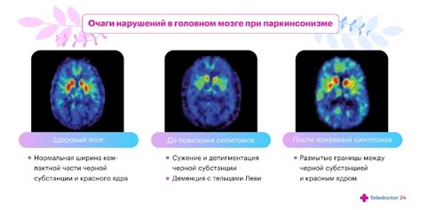 Понятие и описание особенностей симптомов синдрома Паркинсона 