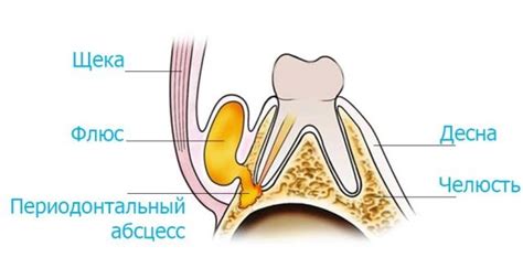 Понятие флюса и его причины