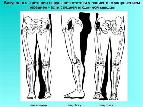 Последствия нарушения статики гоп