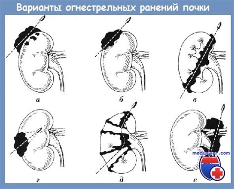 Последствия оторванной почки при поднятии тяжести