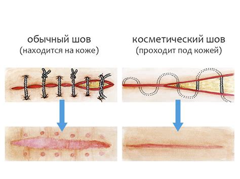 После удаления швов на животе: душ