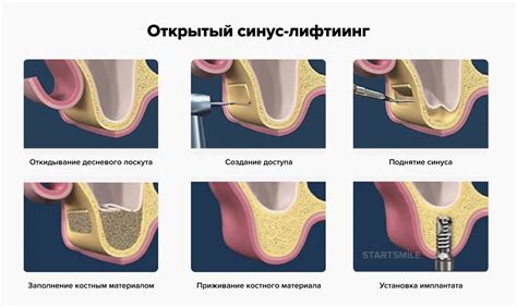 Потенциальные риски синус лифтинга