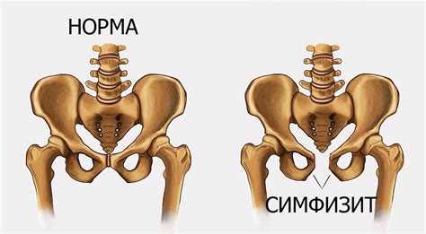 Почему болят кости таза