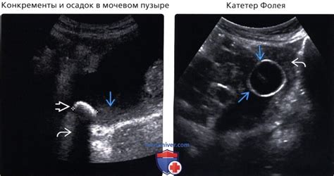 Почему возникает анэхогенное содержимое мочевого пузыря