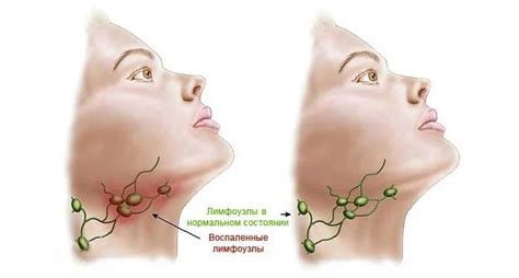 Почему возникает увеличение лимфоузлов