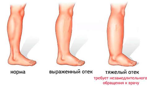 Почему возникают отек и боль в ноге: рассмотрим причины и методы лечения