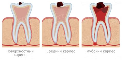 Появление налета и темных пятен