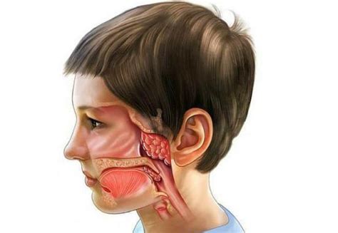 Предотвращение роста аденоидов после операции