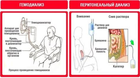 Преимущества домашнего диализа