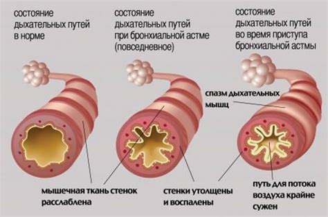 Причины возникновения бронхоспазма