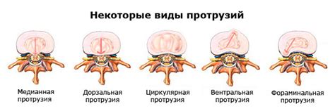 Причины возникновения дорзальных протрузий дисков l3-5