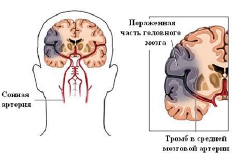 Причины возникновения ишемических атак