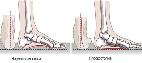 Причины возникновения плоскостопия