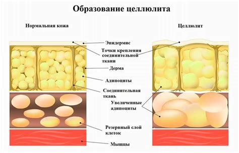 Причины возникновения целлюлита