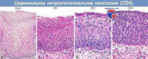 Причины возникновения цервикальной интраэпителиальной неоплазии 1 степени