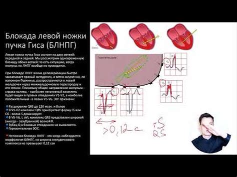 Причины нарушения внутрижелудочковой проходимости