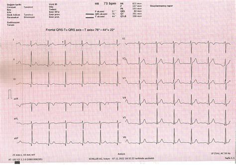 Причины нарушения контура QRS-T