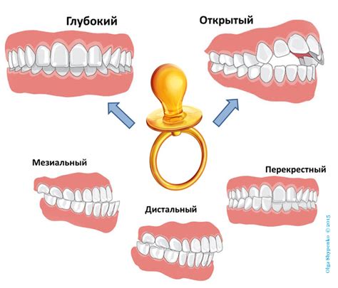 Причины нарушения прикуса