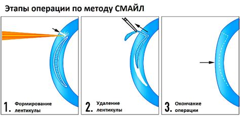 Причины неудачных операций по коррекции зрения