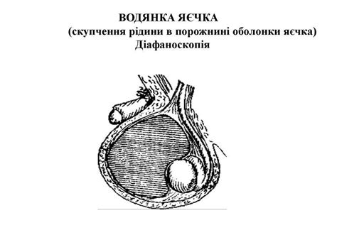 Причины образования водянки