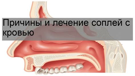 Причины образования соплей