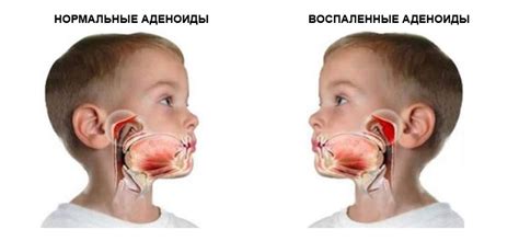 Причины появления храпа после удаления аденоидов