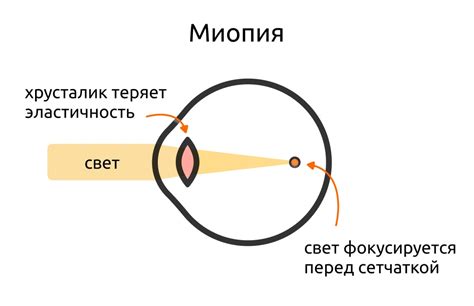 Причины рефракции глаза