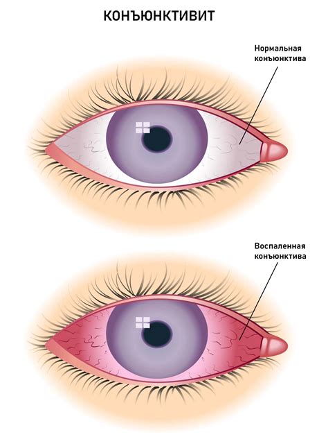 Проблема конъюнктивита: симптомы, причины и возможные осложнения
