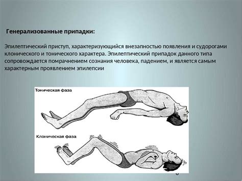 Происхождение и механизмы развития эпилепсии у людей со стабильным здоровьем