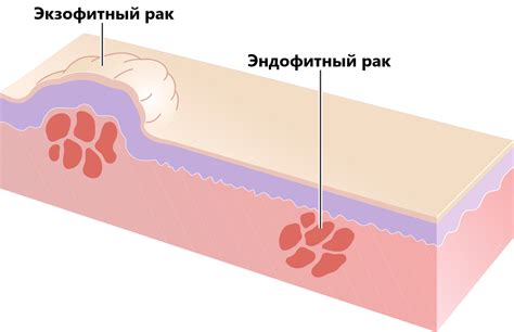 Профилактика образования язвы с подложным структурным образованием