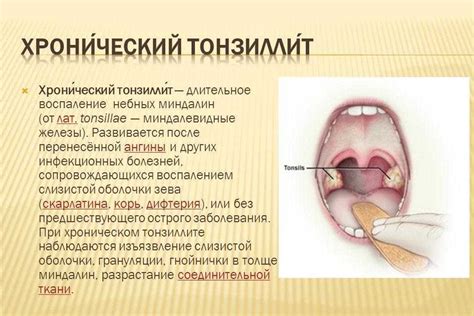 Профилактика увеличения миндалин