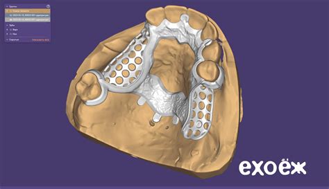 Работа с бюгелем в программе exocad