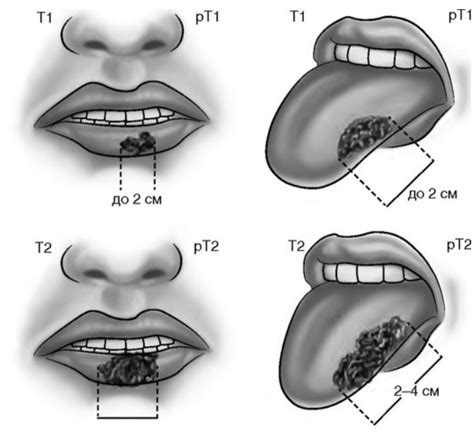Раковые опухоли в полости рта