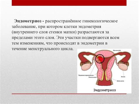 Распространенное гинекологическое заболевание: проблема, затрагивающая множество женщин