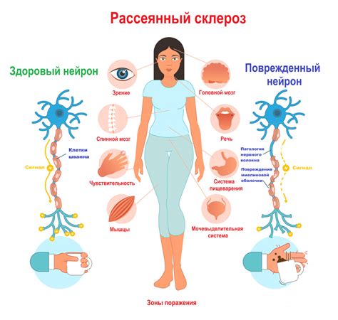 Рассеянный склероз: симптомы, причины и диагностика