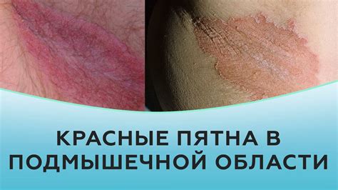 Реакция кожи на ультрафиолет и темные пятна под мышками