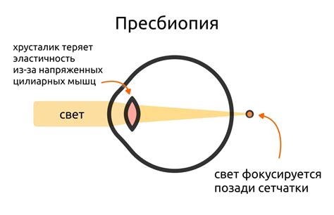 Рефракция глаза: объяснение и механизмы нарушения