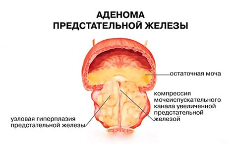 Роль аденомы простаты в изменении показателей артериальной гемодинамики