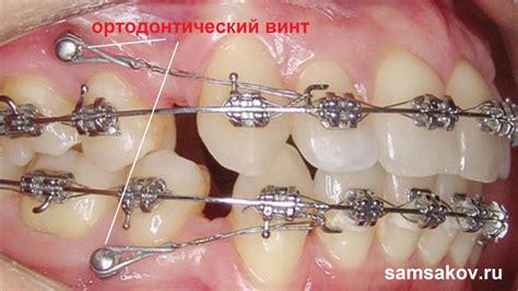 Роль брекетов в ортодонтическом лечении