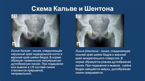 Роль линии Шентона