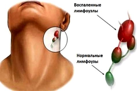 Рост лимфоузла на шее: основные симптомы и проявления