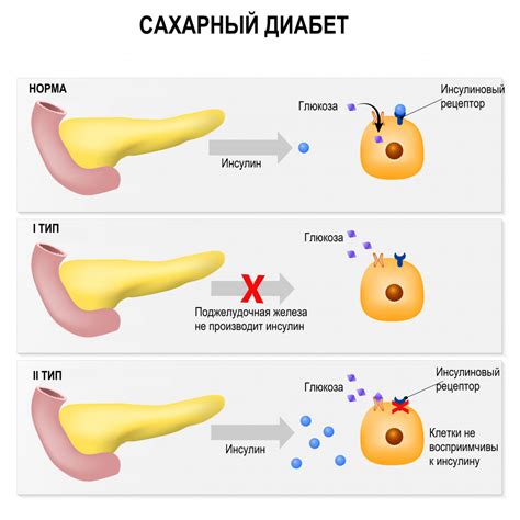 Сахарный диабет и его наследственность