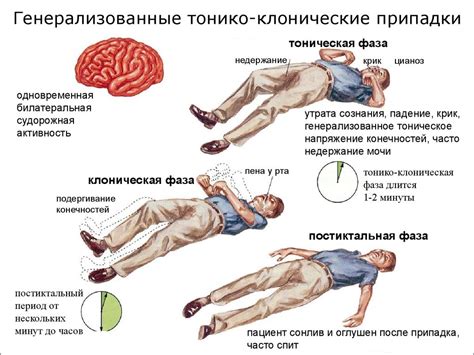 Симптомы генерализованной эпилепсии