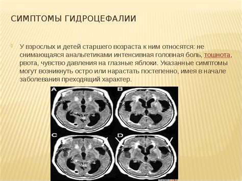 Симптомы гидроцефалии у взрослых