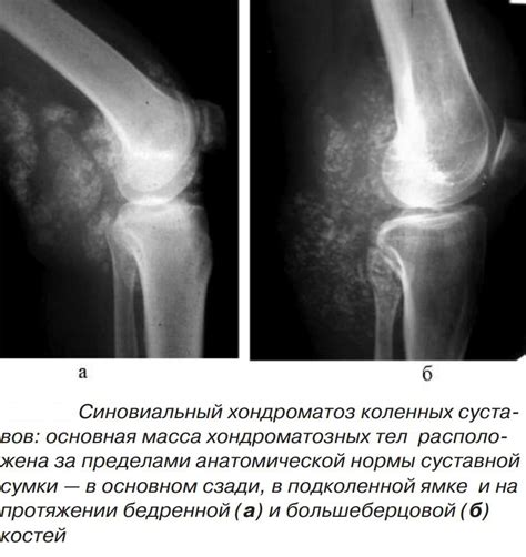 Симптомы гоналгии коленного сустава справа