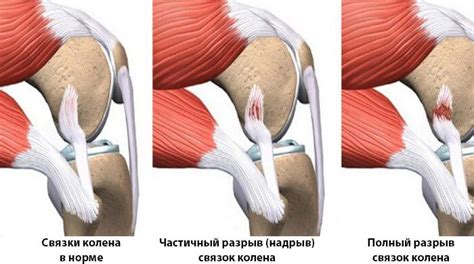 Симптомы застудления колен