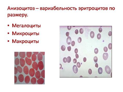 Симптомы и диагностика анизоцитоза