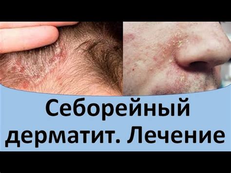 Симптомы и лечение себорейного дерматита