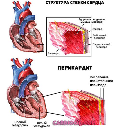 Симптомы и причины нарушения внутрижелудочковой проводимости сердца