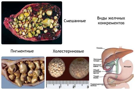 Симптомы камней желчного пузыря